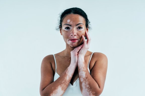 Psoríase Brasil lança a campanha “Cor da Vida” para exigir políticas públicas JÁ para o vitiligo